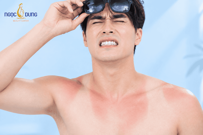 Cách phục hồi da bị cháy nắng nhanh chóng