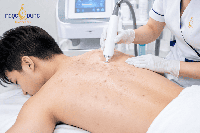 Trị mụn lưng ở nam giới tại TMV Ngọc Dung