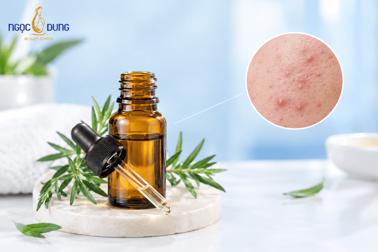 Trị mụn ở tuổi dậy thì cho nam bằng tinh dầu