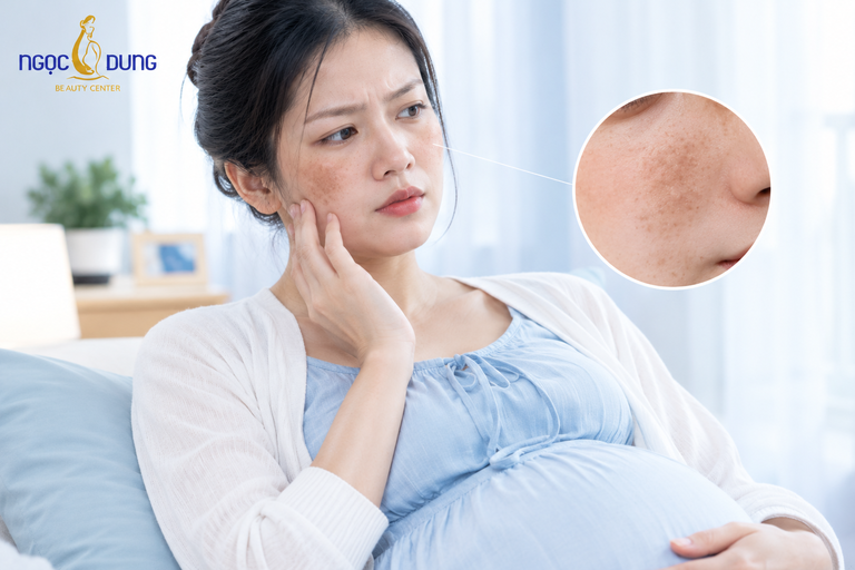 Cách trị nám da cho bà bầu an toàn