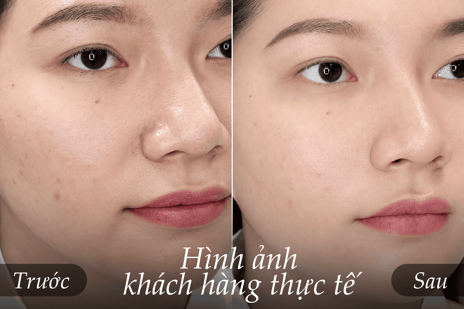 Hình ảnh thực tế của khách hàng trước và sau khi trải nghiệm liệu trình ECM Skin Rebuild tại TMV Ngọc Dung