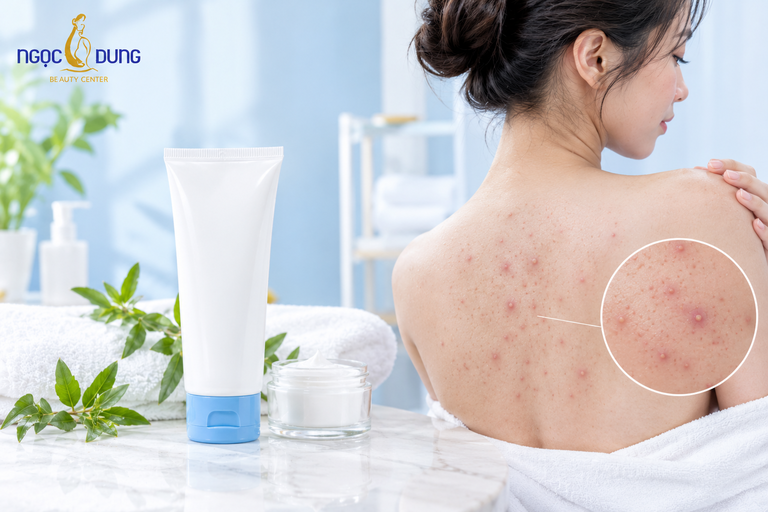 Kem trị mụn lưng: Các tiêu chí lựa chọn hàng đầu